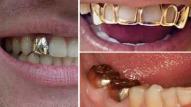 استخدام الذهب في طب الأسنان